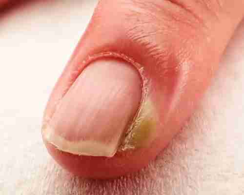 What Causes Hangnails? The Ultimate Guide