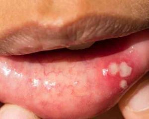 TEA TREE OIL FOR CANKER SORES