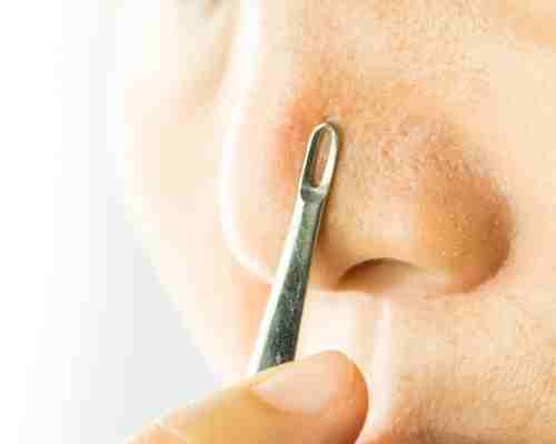 What Are the Most Common Causes of Blackheads
