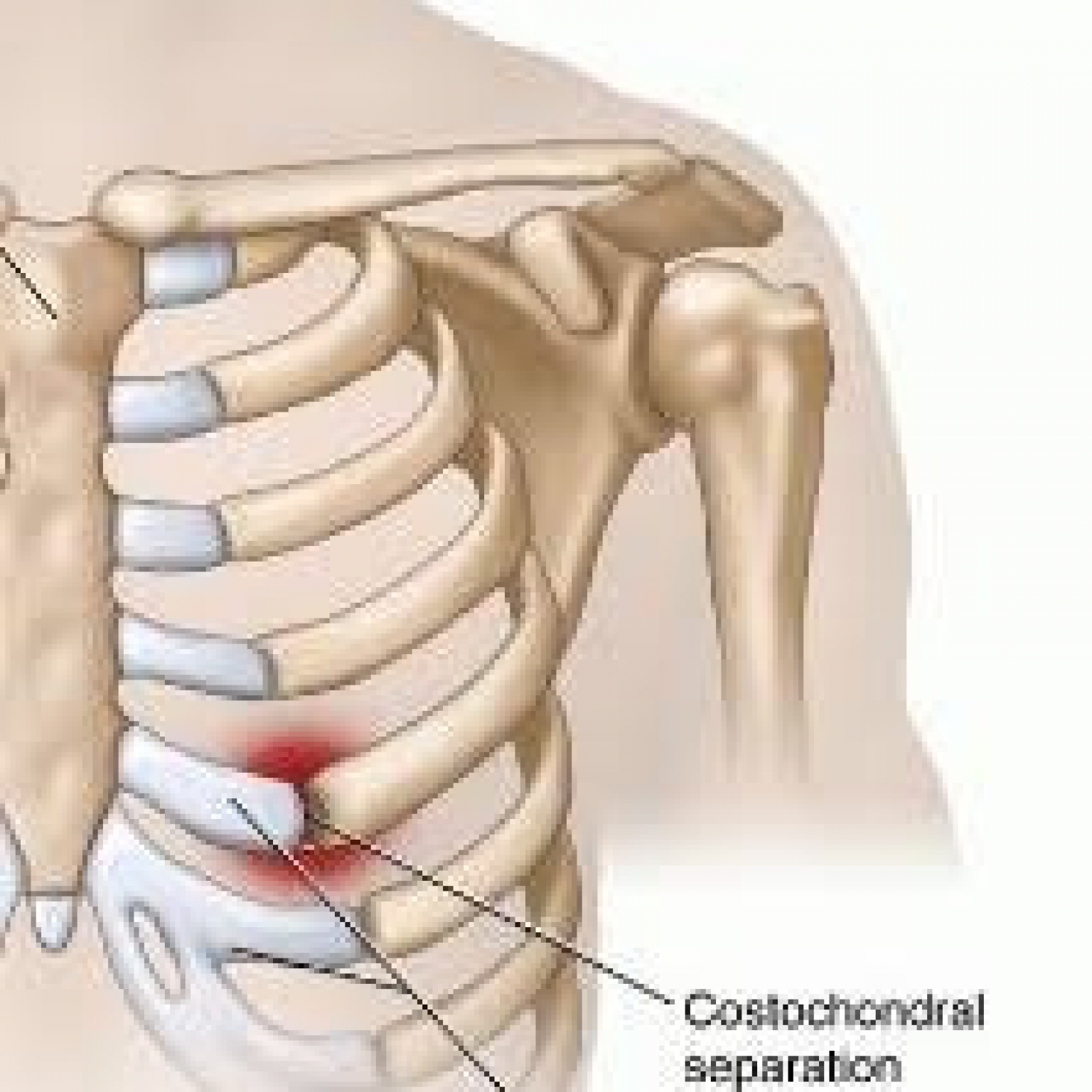 What is Costochondral Separation? Causes Symptoms Treatment