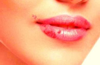 white spots on lips