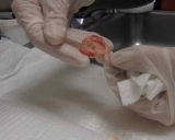 Decidual Cast (Womb Tissues)