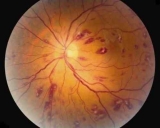 What are Roth Spots? Diagnosis  | Symptoms | Treatment